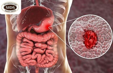 Gastrointestinal Perforation: Causes, Symptoms & Diagnosis | by SIDS ...