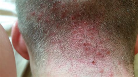 Scalp Bumps Large Bumps On Scalp Red Bumps On My Scalp Itchy Bumps ...