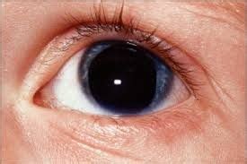 aniridia - Google Search | Parts of the eye, Optometry, Learn facts