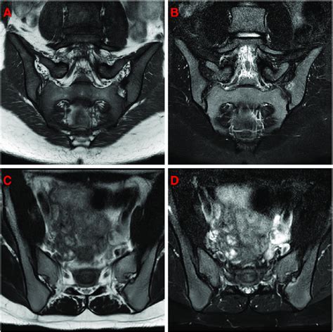 MRI of the sacrum/pelvis performed 4 years earlier with (A) coronal T1 ...