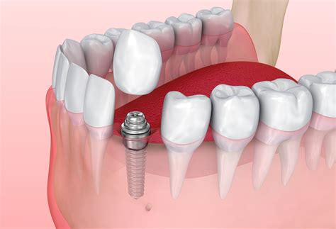 Dental Implant for Single Tooth Replacement - East Honolulu - Hawaii Kai