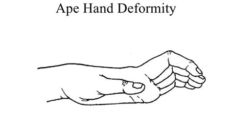 Ape Hand Deformity - Cause, Symptoms, Treatment, Exercise