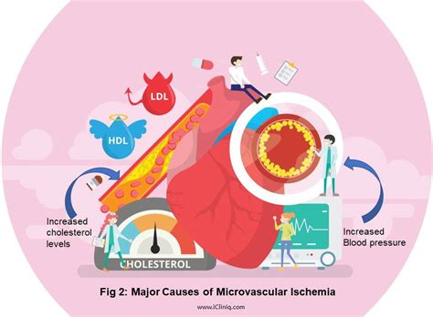 Microvascular Ischemic Disease - Symptoms | Causes | Diagnosis ...