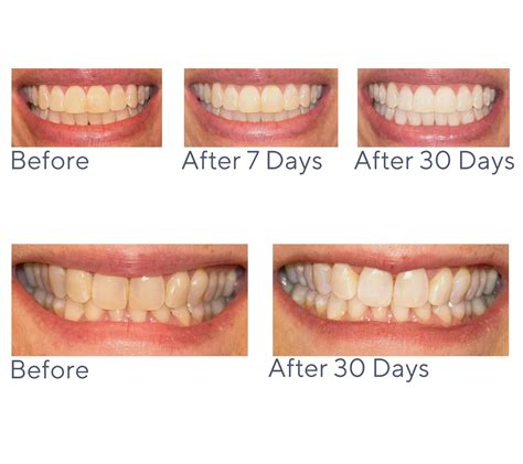 Smileactives Vibrite Blue + Pro Whitening Gel - QVC.com