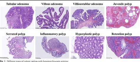 Colonoscopy Polyps Types