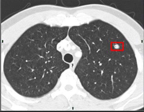 Lung Cancer and Thoracic Surgery Today: Staging