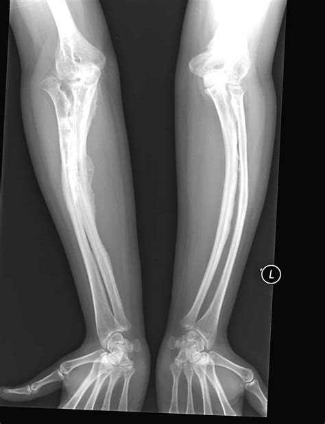 Brittle bone disorder - Costamedic