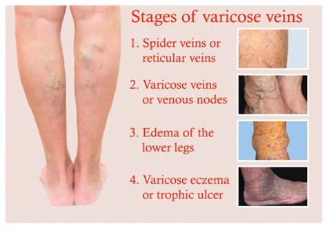 Vein Disorders - Vein Specialists of the Carolinas - "All We Do Is ...