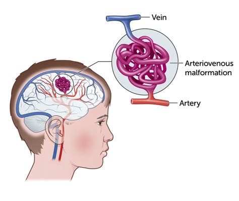 ARTERIOVENOSUS MALFORMATION – Unitamed