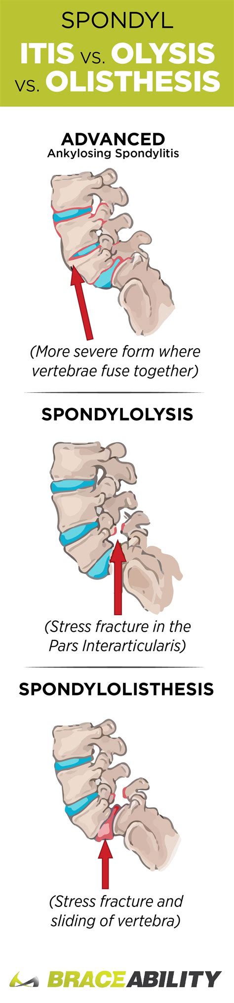 Spondylitis | Spondylolisthesis, Physical therapy, Types of arthritis