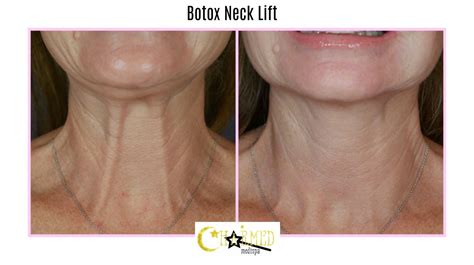 Botox® Dysport® Daxxify – Charmed Medispa