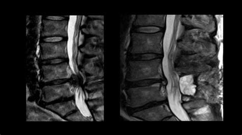 Cauda Equina Syndrome With Normal Mri Imaging The Meta Pictures | The ...