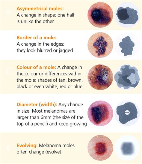 Malignant Melanoma Symptoms - Doctor Heck