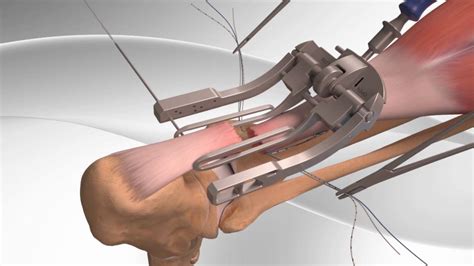 Achilles Tendon Rupture - Carolina Regional Orthopedics