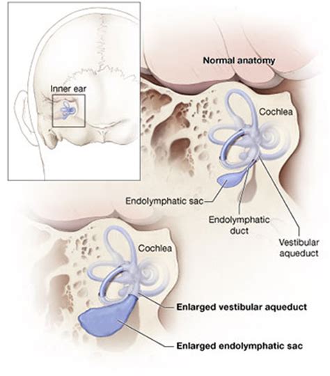 What Is Pendred Syndrome? Causes & Treatment | NIDCD