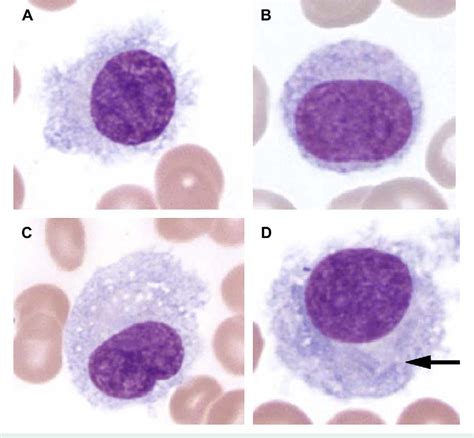 Figure 1 from OF NORTH AMERICA Hairy Cell Leukemia : Diagnostic ...