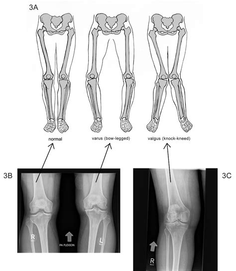 valgus knee - Google Search | Scoliosis exercises, Osteopathy, Pilates