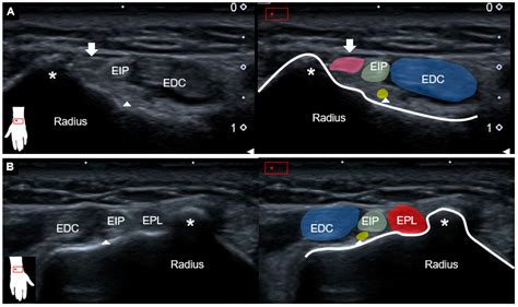 Abductor Pollicis Longus Mri