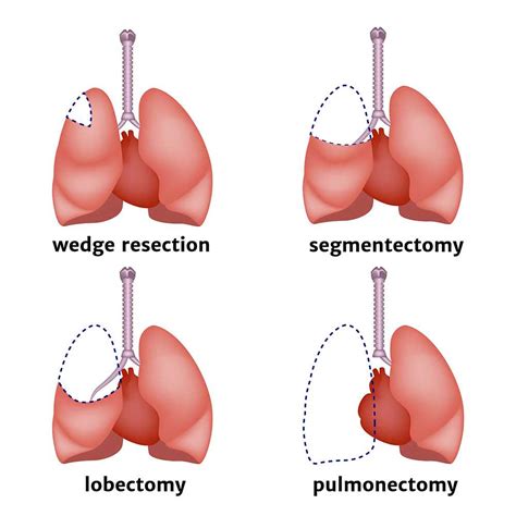 Lung Cancer Surgery: A Guide for Patients | Gold Coast