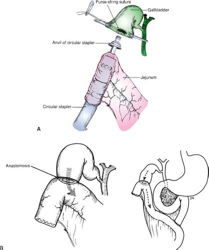 Choledochoenteric Anastomosis by Choledochoduodenostomy and Other ...