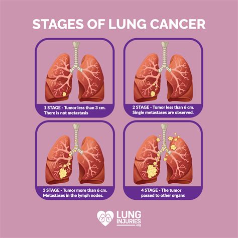 Stage 2 Of Lung Cancer