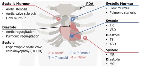 Aortic Stenosis Murmur