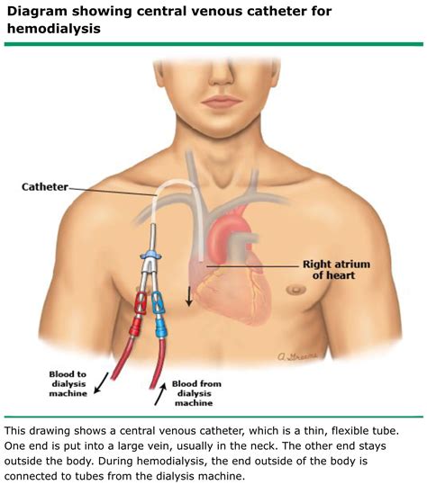 Central Venous Catheter (HD) | Central venous catheter, Catheter ...