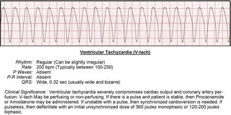 Ventricular Tachycardia (V-tach) ECG - ACLS Wiki