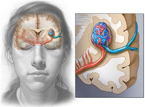 Arteriovenous Malformation - Brain Avm - Causes, Symptoms, Treatment