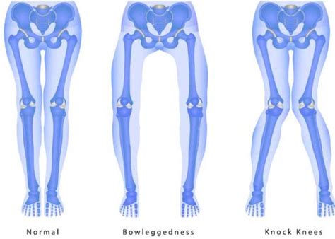 Knee Malalignment | Varus | Valgus| Sugar Land, Pearland, Houston, TX