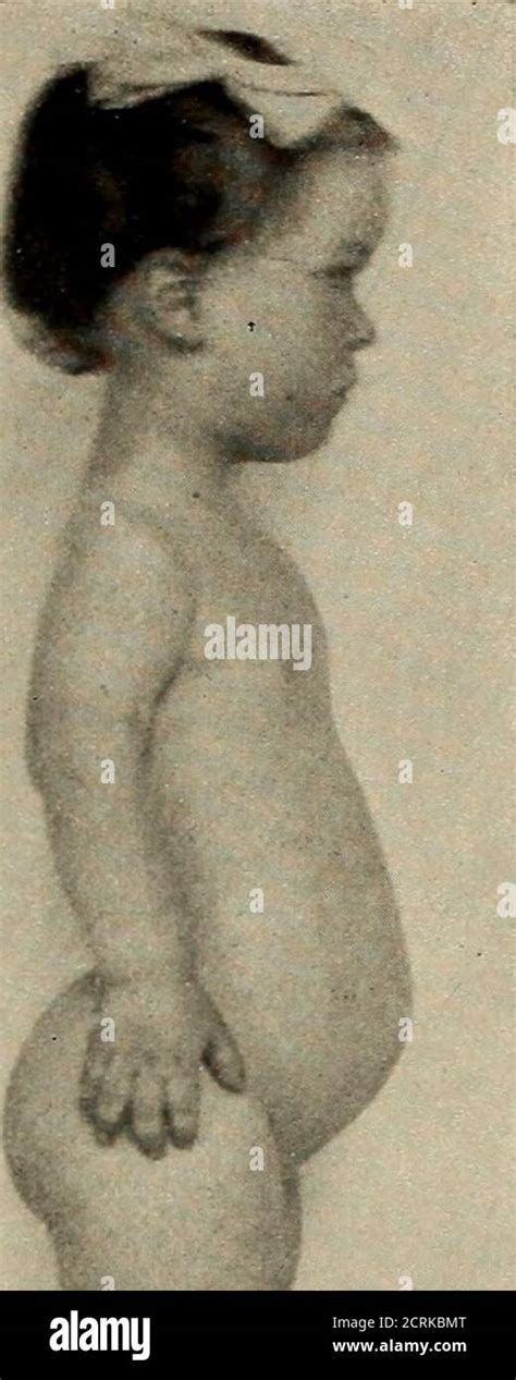 . Living anatomy and pathology; . PLATE 66. CHONDRODYSTROPHY FGETALIS ...