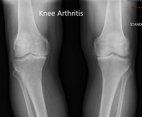 Case Study: Bilateral Customized Total Knee Replacement in a 72-year ...