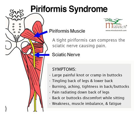 Best 25+ Piriformis syndrome symptoms ideas on Pinterest | Periformis ...