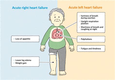 Acute right sided heart failure