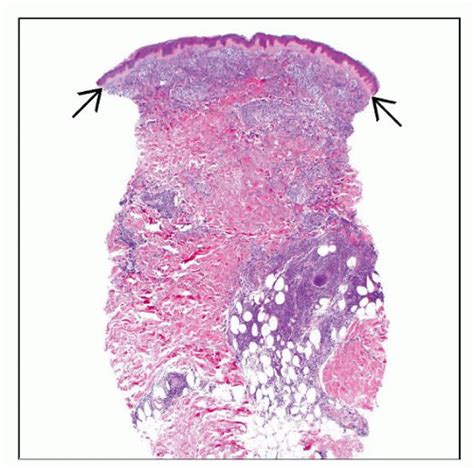 Leukemia Cutis | Basicmedical Key