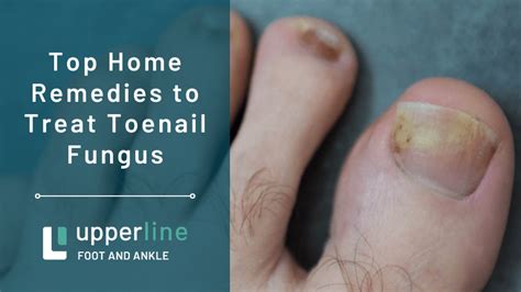 Top Home Remedies to Treat Toenail Fungus