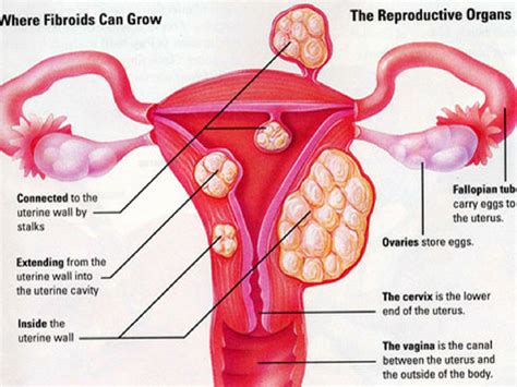 Ramai Wanita Tak Tahu Ada Cyst & Fibroid, Adakah Anda Berisiko ...