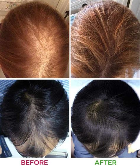 Laser Light For Hair Growth: What Is It And Does It Work? - Woman and ...