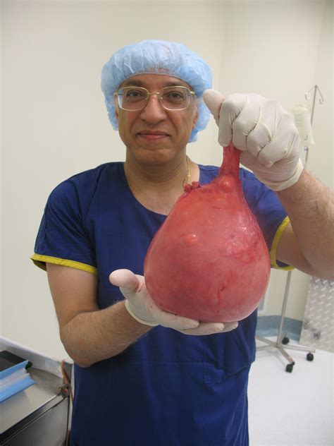 Large Fibroid Uterus Surgery