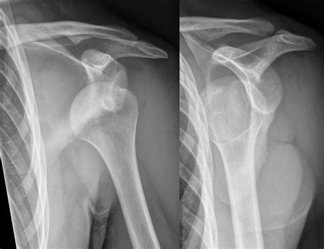 Understanding the Causes of Shoulder Dislocation and Instability ...