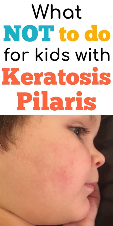 Keratosis Pilaris Treatment: What NOT to do for KP skin | kpkids.net