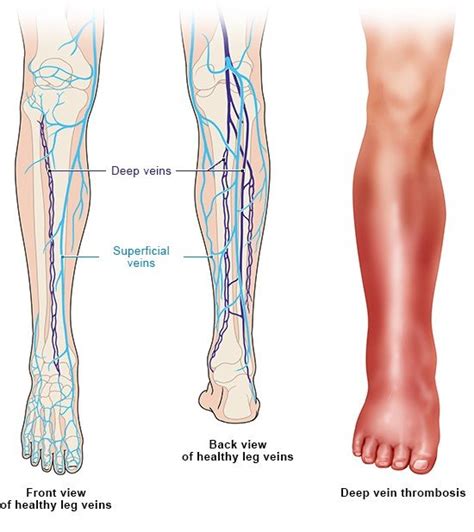 Deep vein thrombosis (DVT) | informedhealth.org