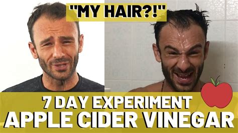 Apple Cider Vinegar Results For Hair Loss (7 DAYS!) - YouTube