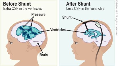 Hydrocephalus (for Parents) | Nemours KidsHealth