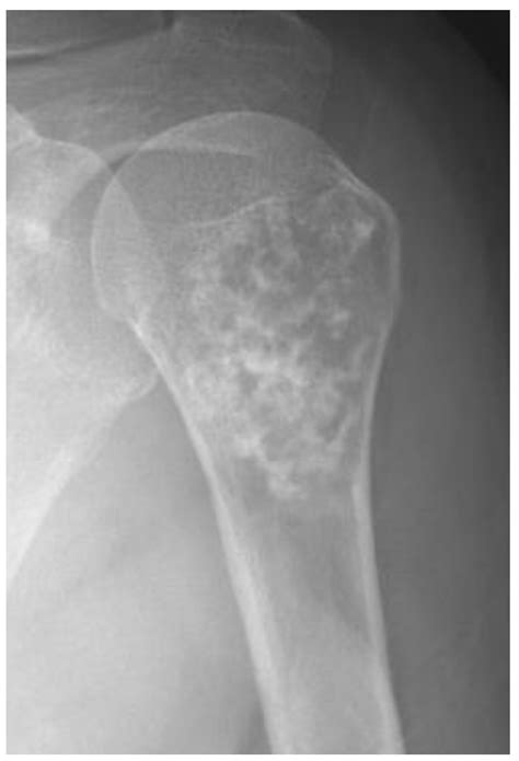 Low Grade Chondrosarcoma Larynx