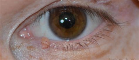 Eyelid papilloma causes, diagnosis & eyelid papilloma treatment