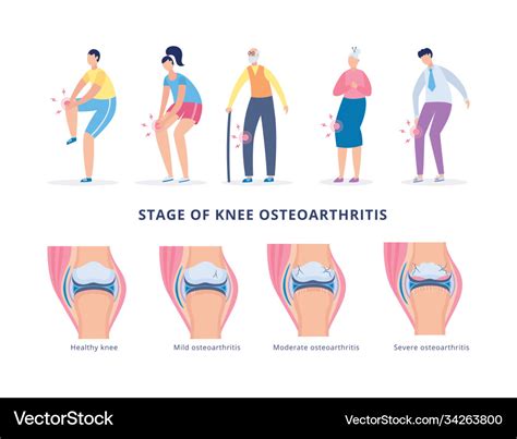 Banner with stages knee osteoarthritis and people Vector Image