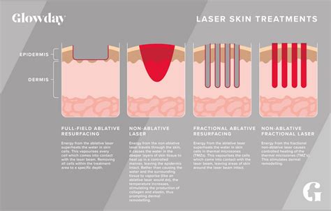 Non-ablative Laser Resurfacing | Glowday