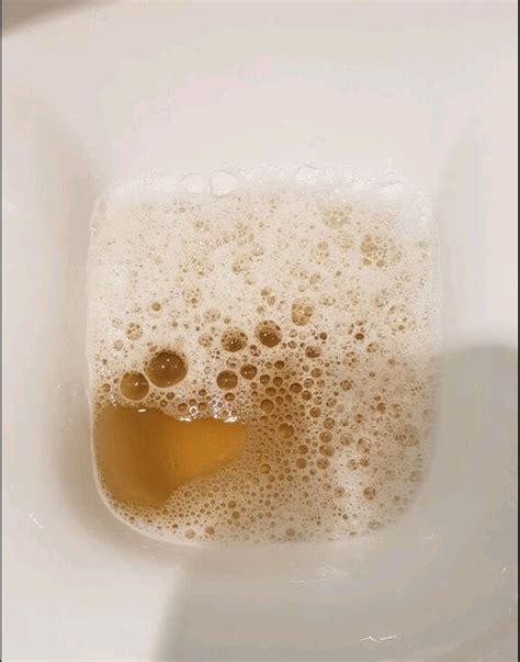 UKidney - Persistently Foamy / Bubbly Urine