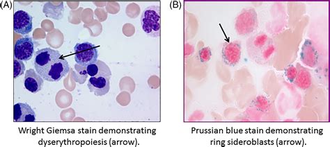 American Journal of Hematology | Blood Research Journal | Wiley Online ...